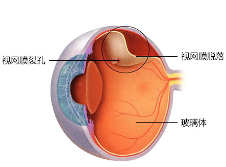 黄金 48 小时！惠州爱尔眼科医院开启视网膜脱离急救绿色通道