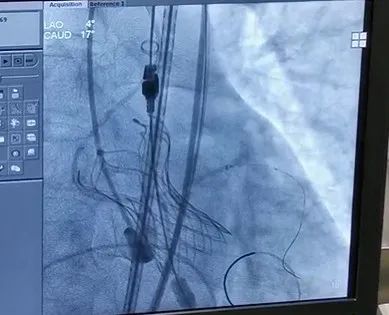 合肥京东方医院首例 TAVR 手术成功,心脏主动脉瓣置换现已进入「介入换新」时代