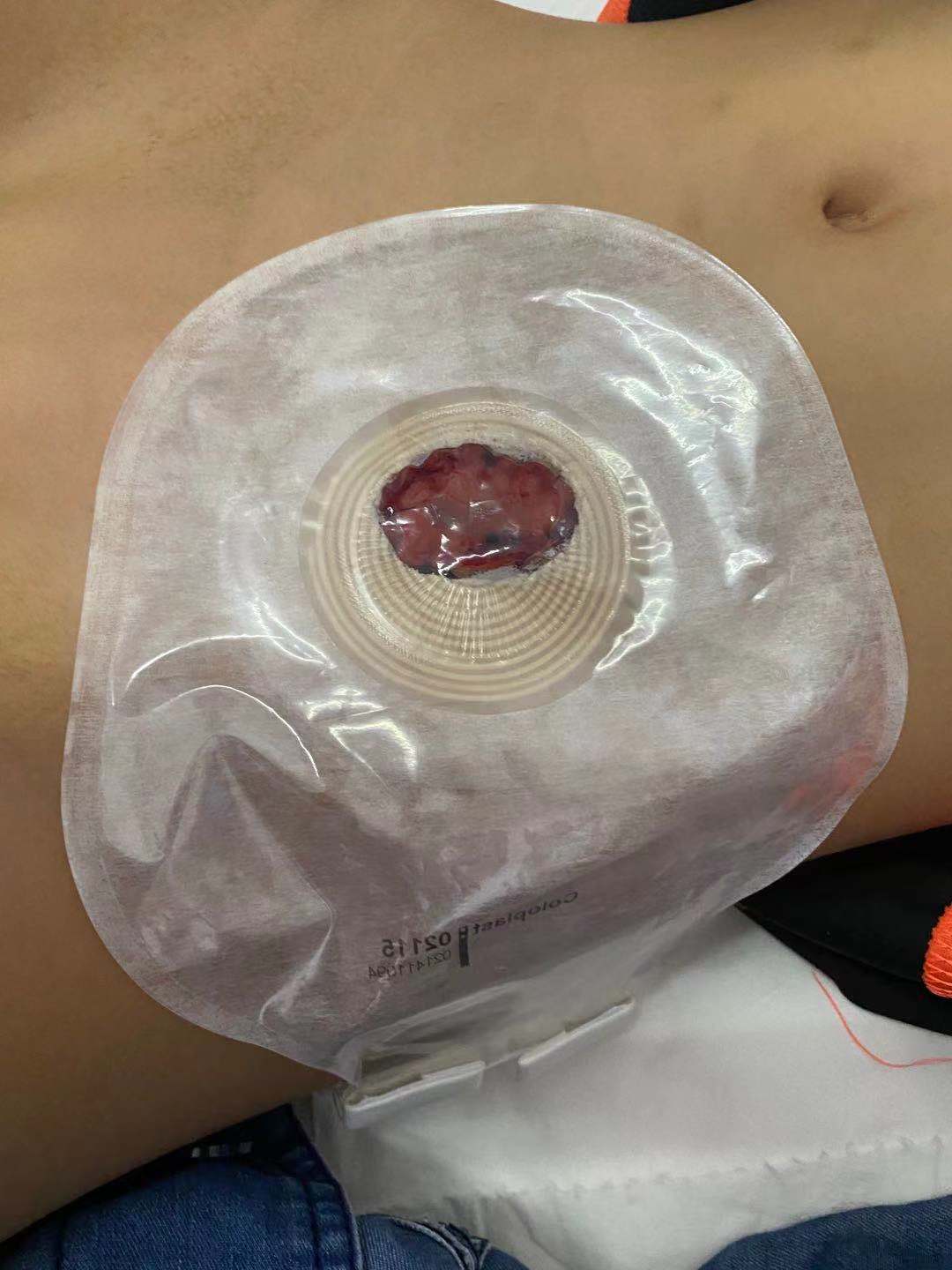 女娃下河戏水屁股被竹签桩插中，江西省儿童医院为其紧急手术重塑肛门、会阴