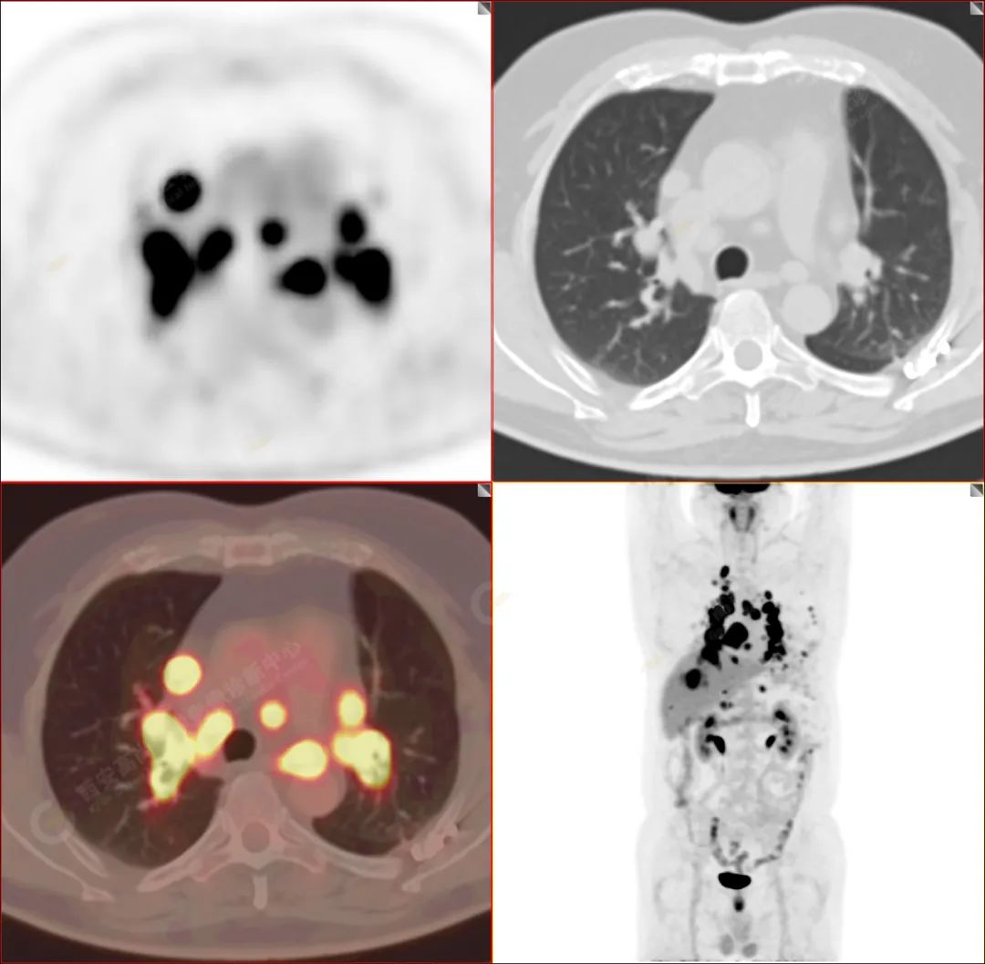 高尚病例：PET/CT-MR 诊断结节病双肺及全身多发淋巴结广泛累及 1 例