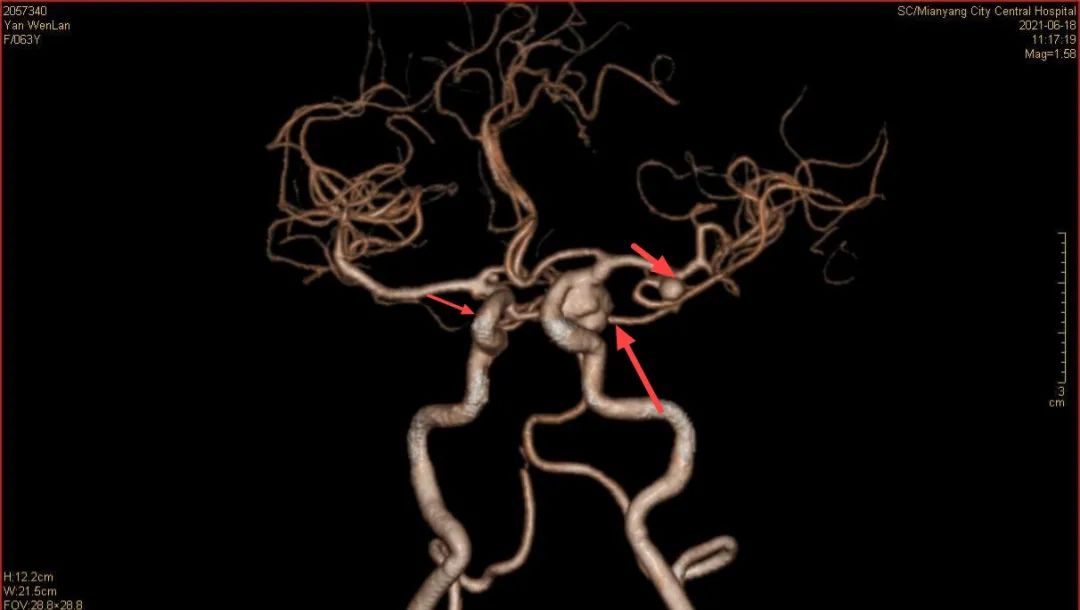 生死时速 绵阳市中心医院神经外科为患者成功摘除多个「颅内炸弹」