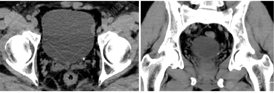 高尚病例:双能量 CT 成像分析泌尿系结石成分