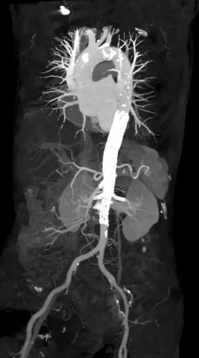 腔内「八爪鱼」技术，满足复杂血管手术需要