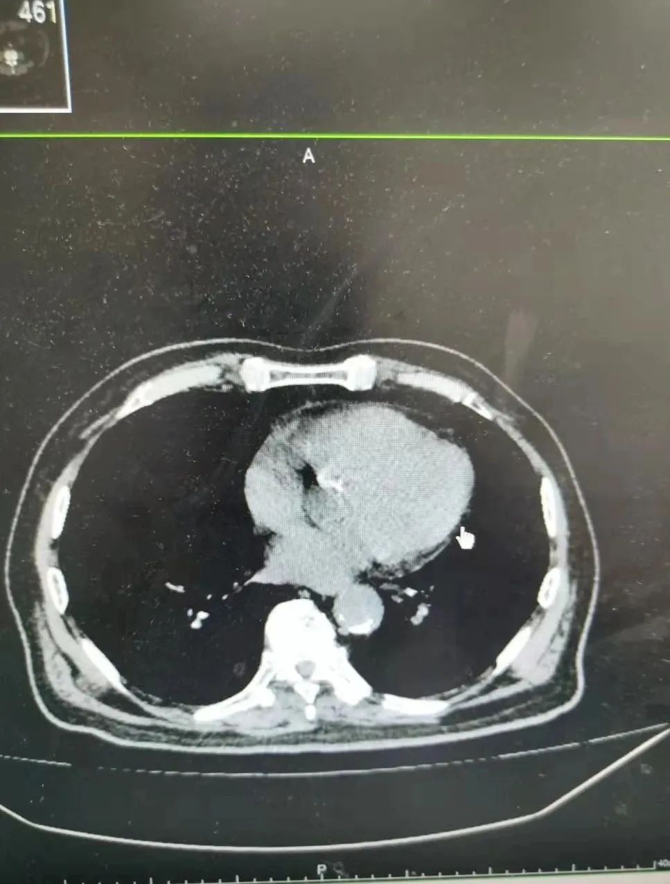 肿块距离「出口」仅 4 公分，医生突破手术极限让 91 岁老人「不改道」