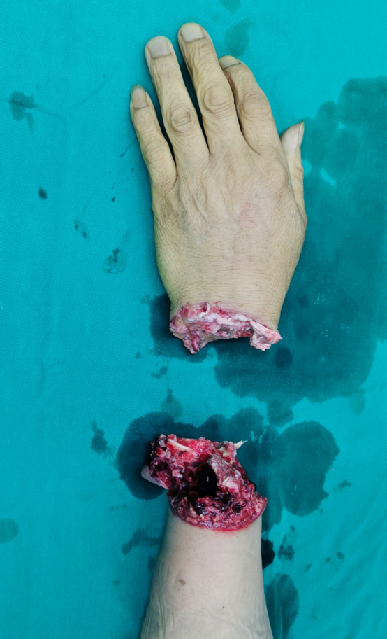 南京江北医院医护奋战 7 小时,让「断腕」重生