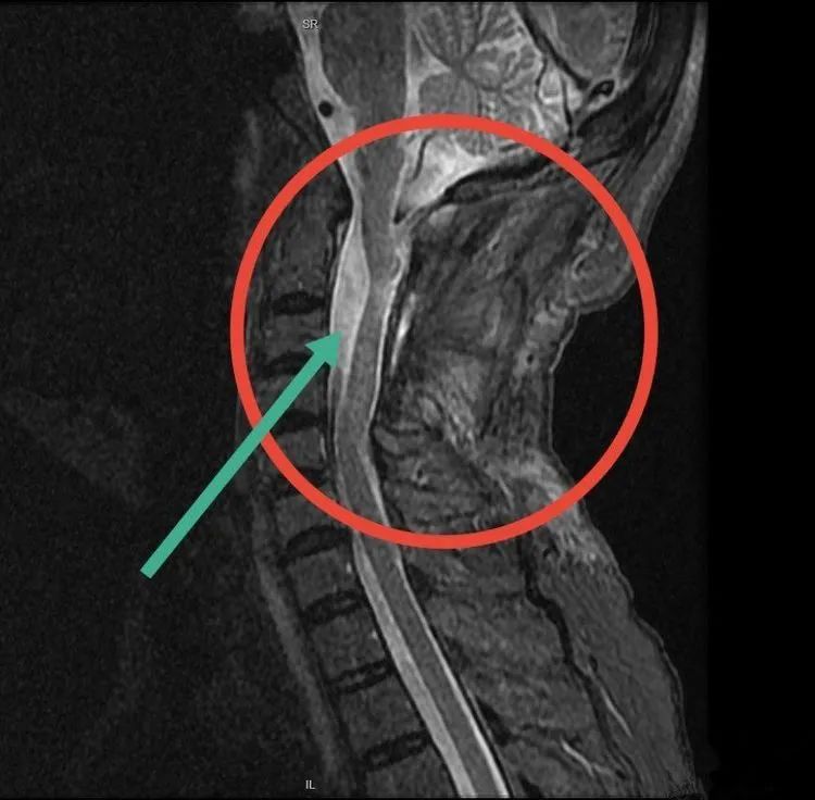 延安大学附属医院脊柱外科成功治愈一例上颈椎椎管内肿瘤患者