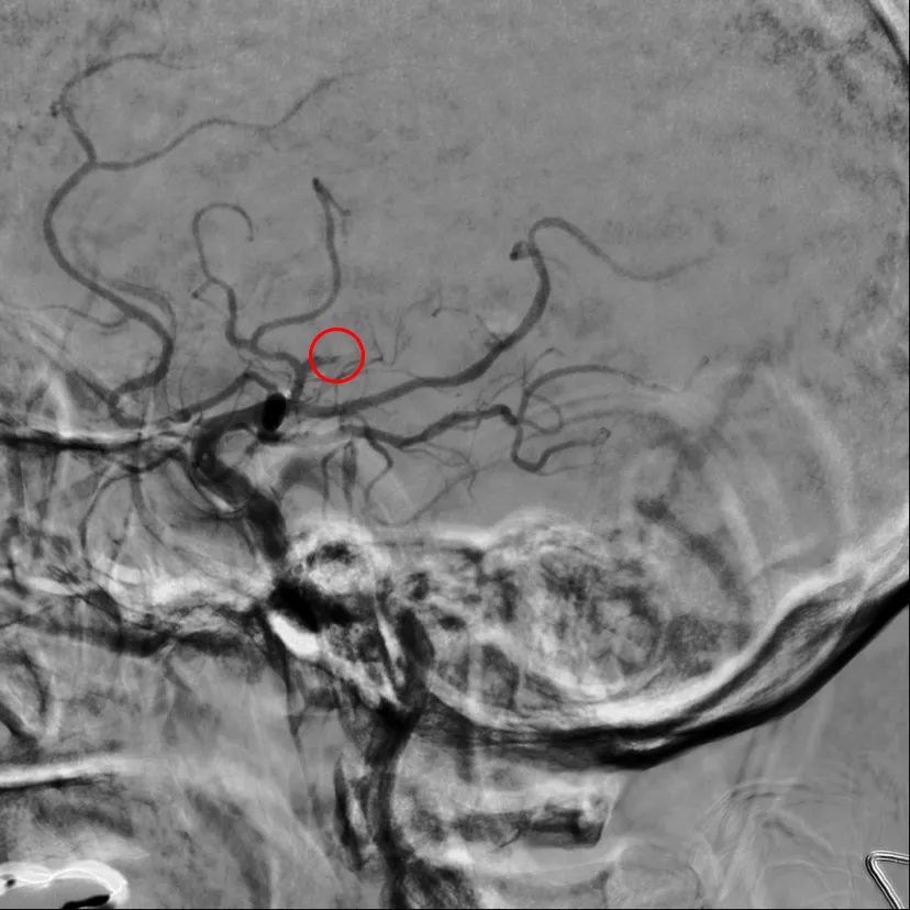 重度中风，致残率高达 75%，7 旬老人却成功逃过偏瘫、失语后遗症