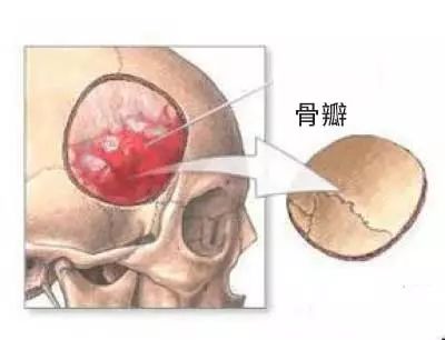 一个直径不足 2 cm 的肿瘤，却令绝大多数医生恐惧