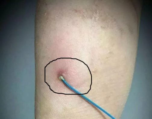 管友之家——西安市中医医院外科 PICC 维护门诊