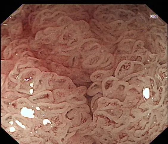 巨大直肠肿瘤，保肛还是保命？ 消化内镜微创手术给出「双保全」的答案