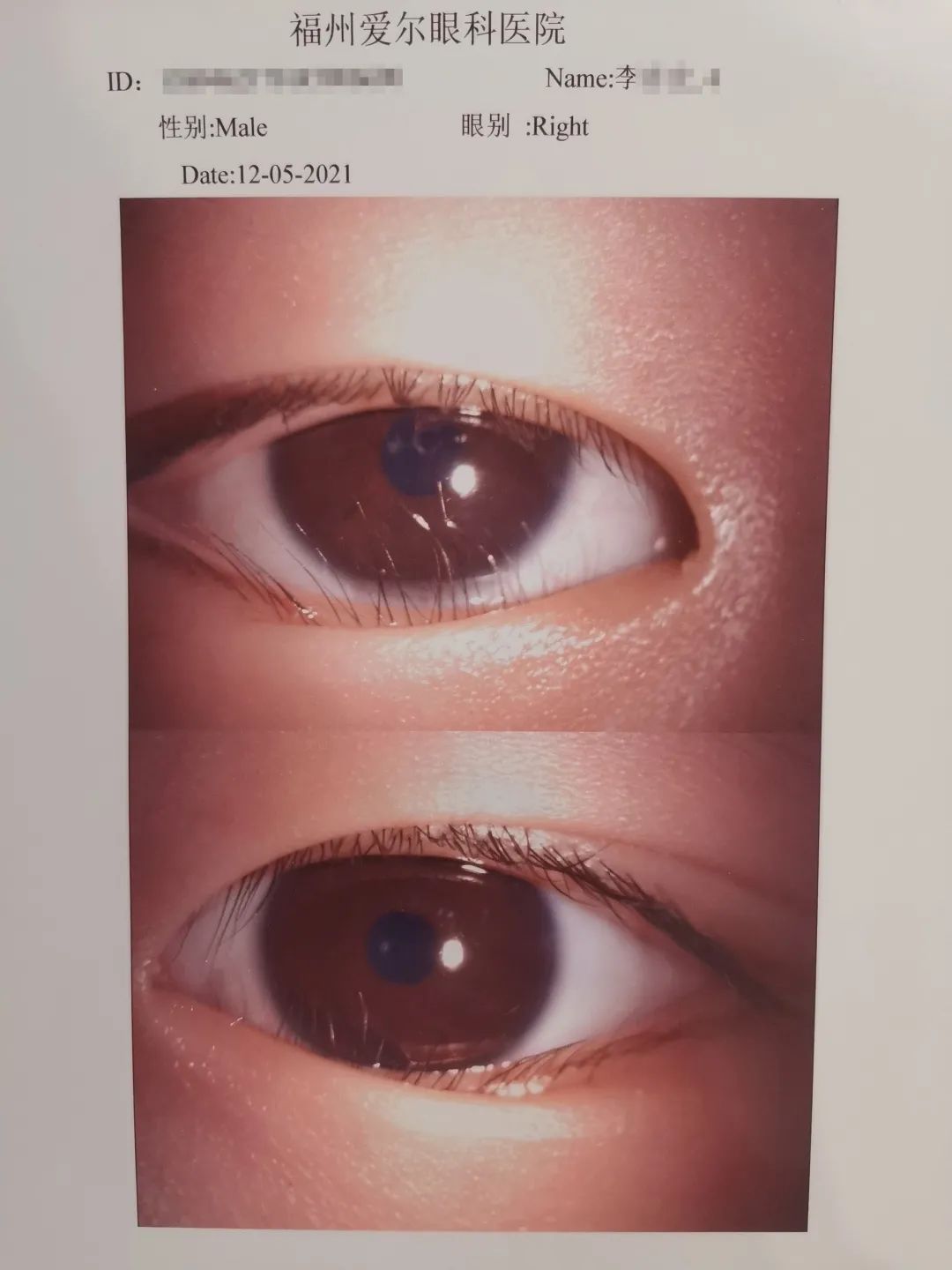 先天性眼睑缺损修复 - 微医（挂号网）