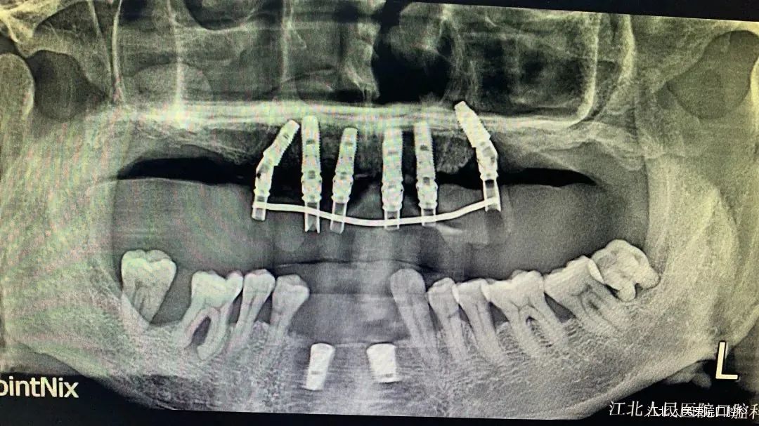 南京江北医院口腔科助力患者重拾笑容和年轻