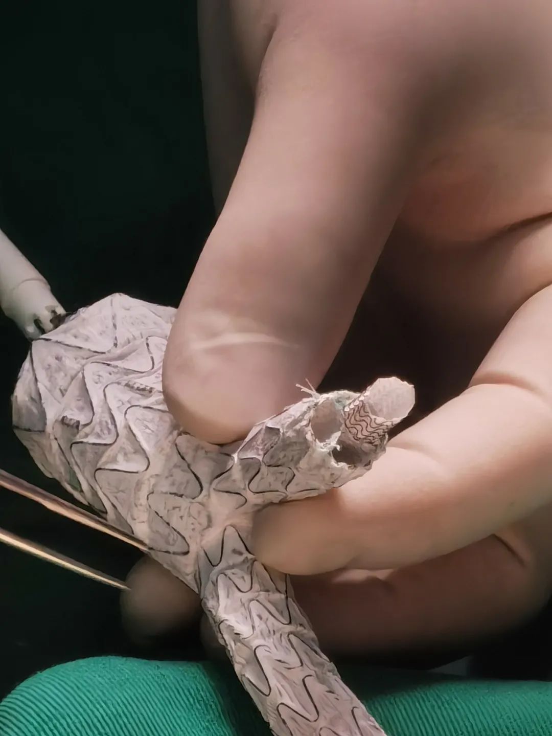 腔内「八爪鱼」技术，满足复杂血管手术需要