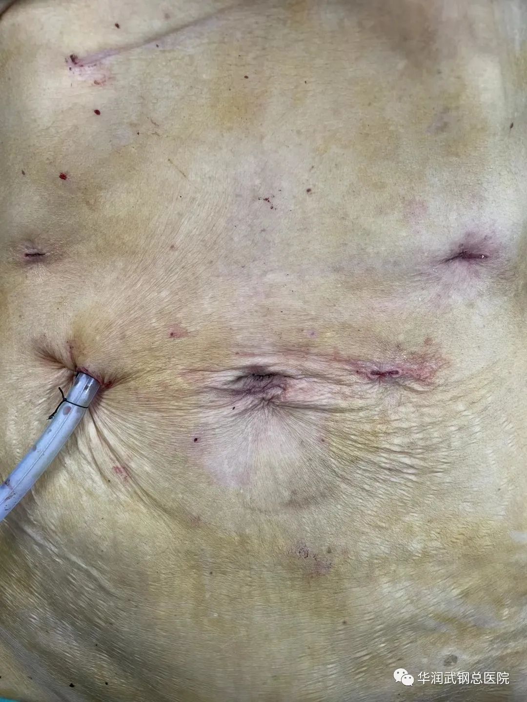 华润总医院胃肠外科完成了首例 3D 腹腔镜胃癌 NOSES 手术