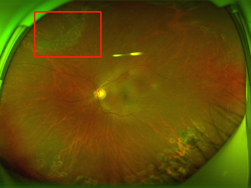 创新复杂玻璃体视网膜疾病手术方式，打造世界眼科领域「深圳样板」