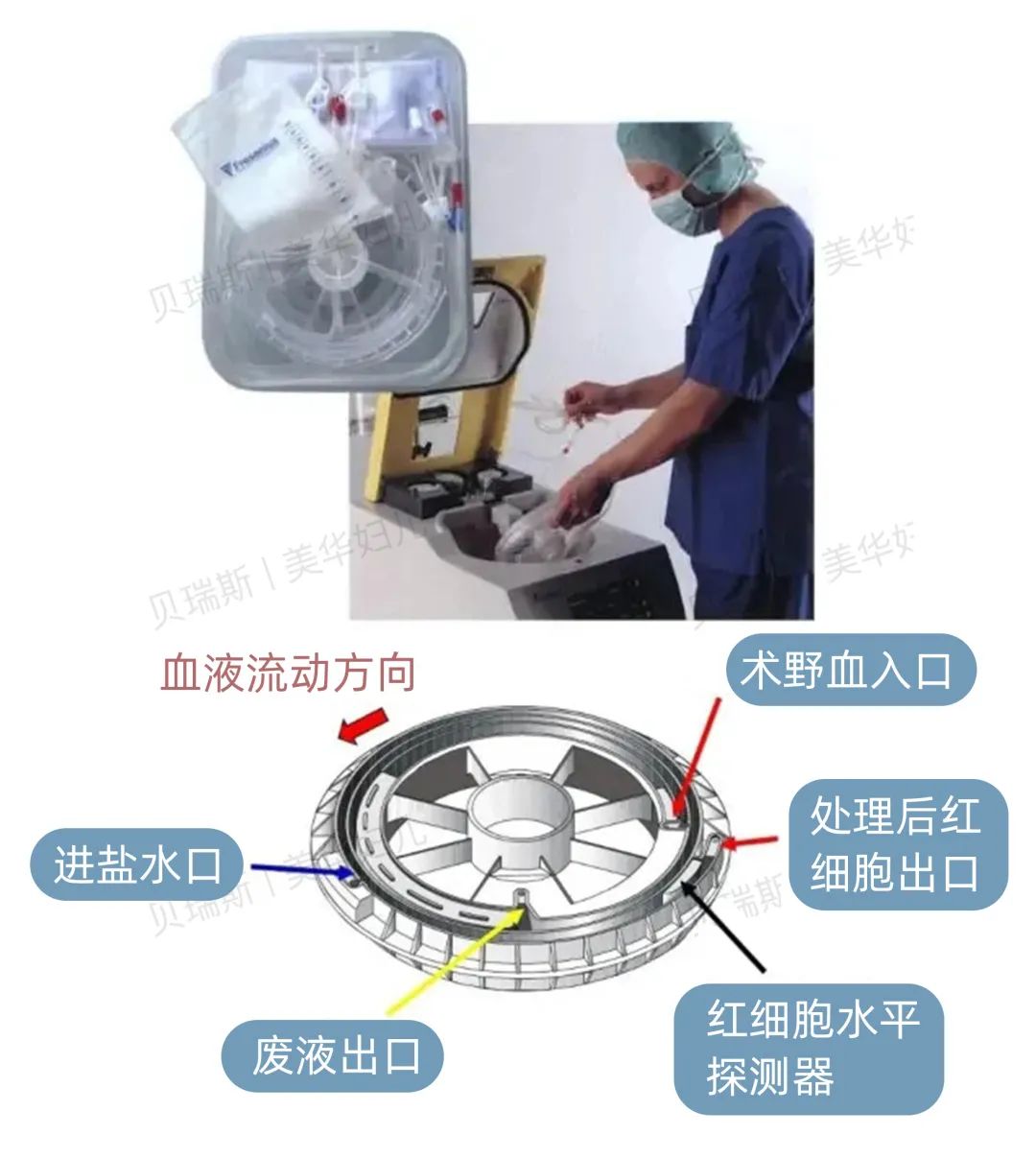 杭州一产妇血流如「自来水」，医生用自体血回输技术救回一命！
