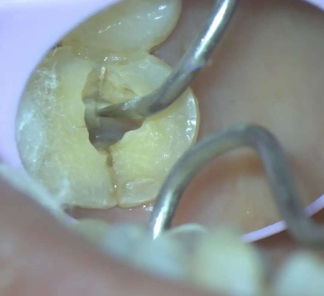 延大附院口腔医院牙体牙髓病科迈入显微治疗时代