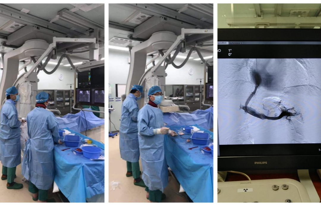 肝脏里的「都江堰」工程，合肥京东方医院成功开展 TIPS 介入手术
