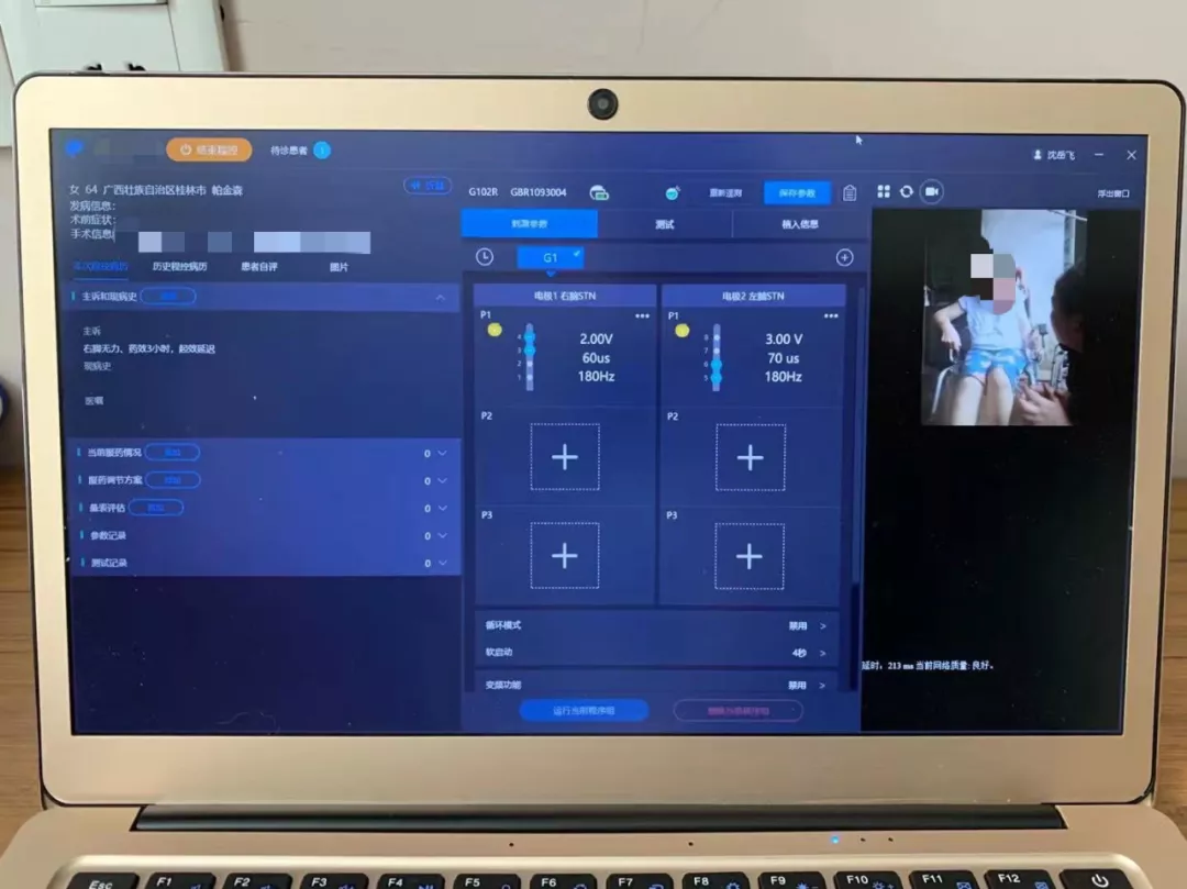 精准高效治疗帕金森：广西医科大学第一附属医院成功开展首例机器人辅助脑深部电刺激（DBS）手术