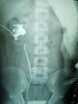 中南大学湘雅二医院成功实施全省首例机器人辅助下输尿管肾下盏吻合术