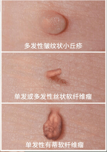 重庆北部宽仁医院科普：皮肤上长了「小肉球」，怎么办？对身体有害吗？