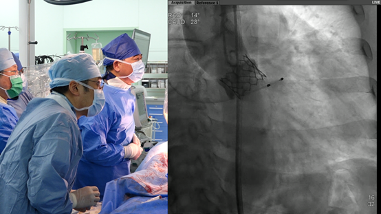院士执刀，上海首例 SAPIEN 3 经导管主动脉瓣膜在上海德达医院成功植入