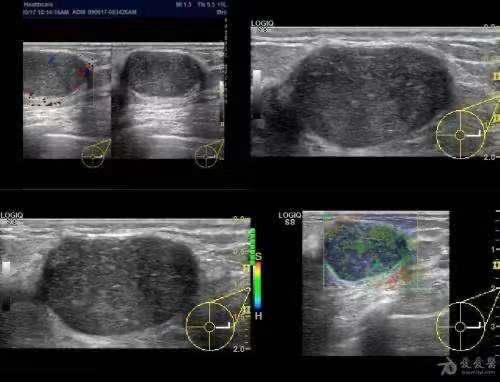乳腺纤维瘤的超声诊断