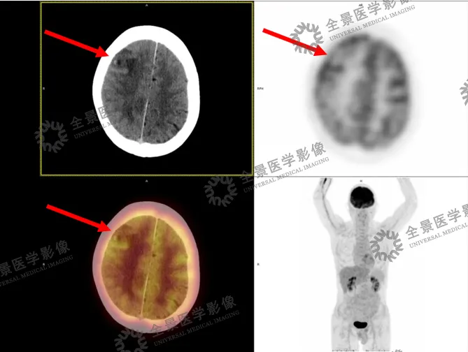 头晕头痛老不好？原来是脑子里长了个大「脓包」