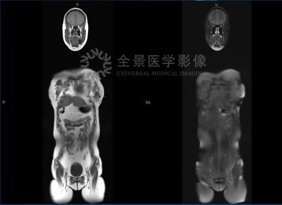 进来抄作业！你想要的全身重疾早筛来了