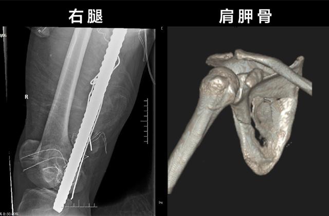 惊险！钢筋贯穿大腿，前海人寿广州总医院骨科团队危难时刻显身手！