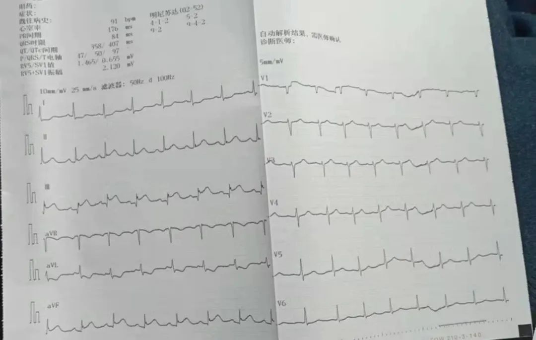 西安大兴医院完成首例降价心脏支架手术