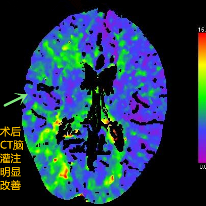 深圳市龙岗区人民医院首例大脑中动脉慢性闭塞介入开通术
