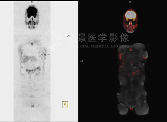 进来抄作业！你想要的全身重疾早筛来了