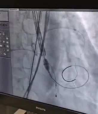 合肥京东方医院首例 TAVR 手术成功,心脏主动脉瓣置换现已进入「介入换新」时代