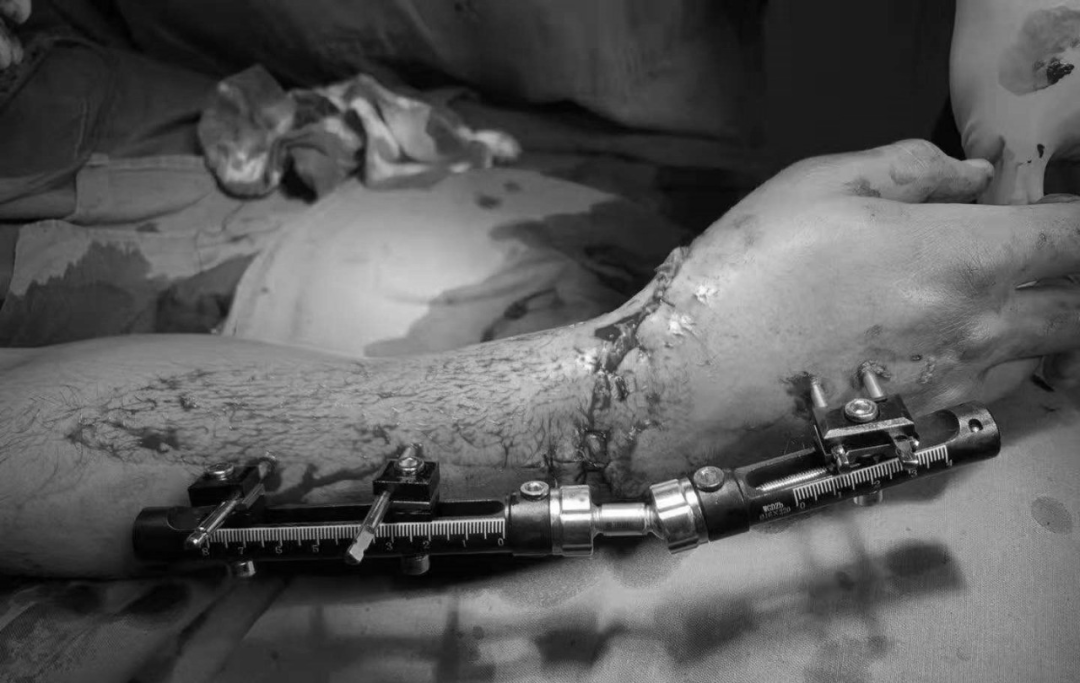 争分夺秒：喀什地区第一人民医院成功完成一例断肢再植手术