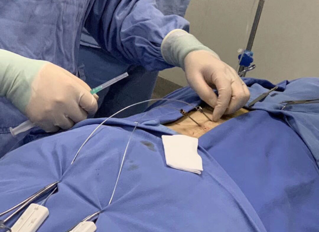 桂林医学院附属医院完成广西首例可充电式脊髓神经刺激系统植入手术