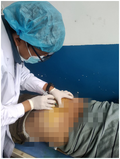 延大附院援藏医疗队成功开展骶管神经阻滞下肛周低位脓肿切开术