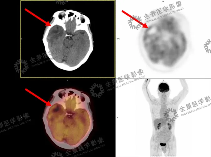 头晕头痛老不好？原来是脑子里长了个大「脓包」