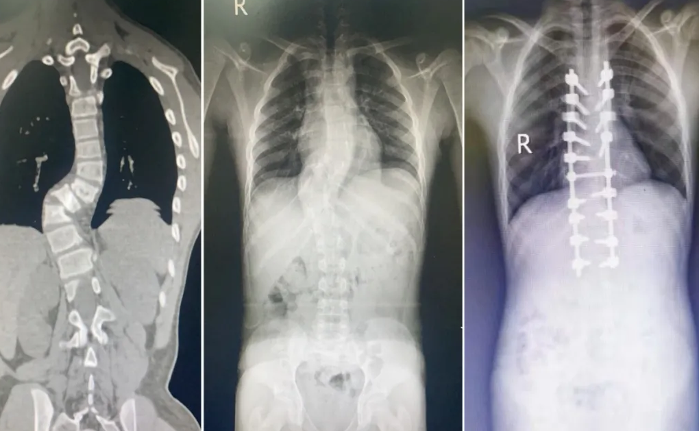 喀什地区第一人民医院联手南方医科大学第三附属医院,助力侧弯少年挺直腰杆