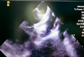 深圳市首例!龙岗区人民医院为房颤、房缺患者消除「隐形炸弹」!