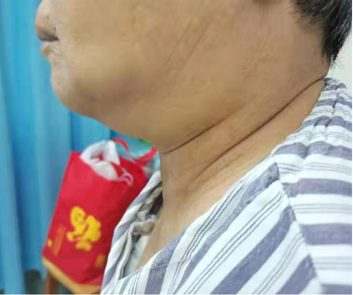 广西中医药大学第一附属医院仙葫院区普通外科成功开展甲状腺消融手术