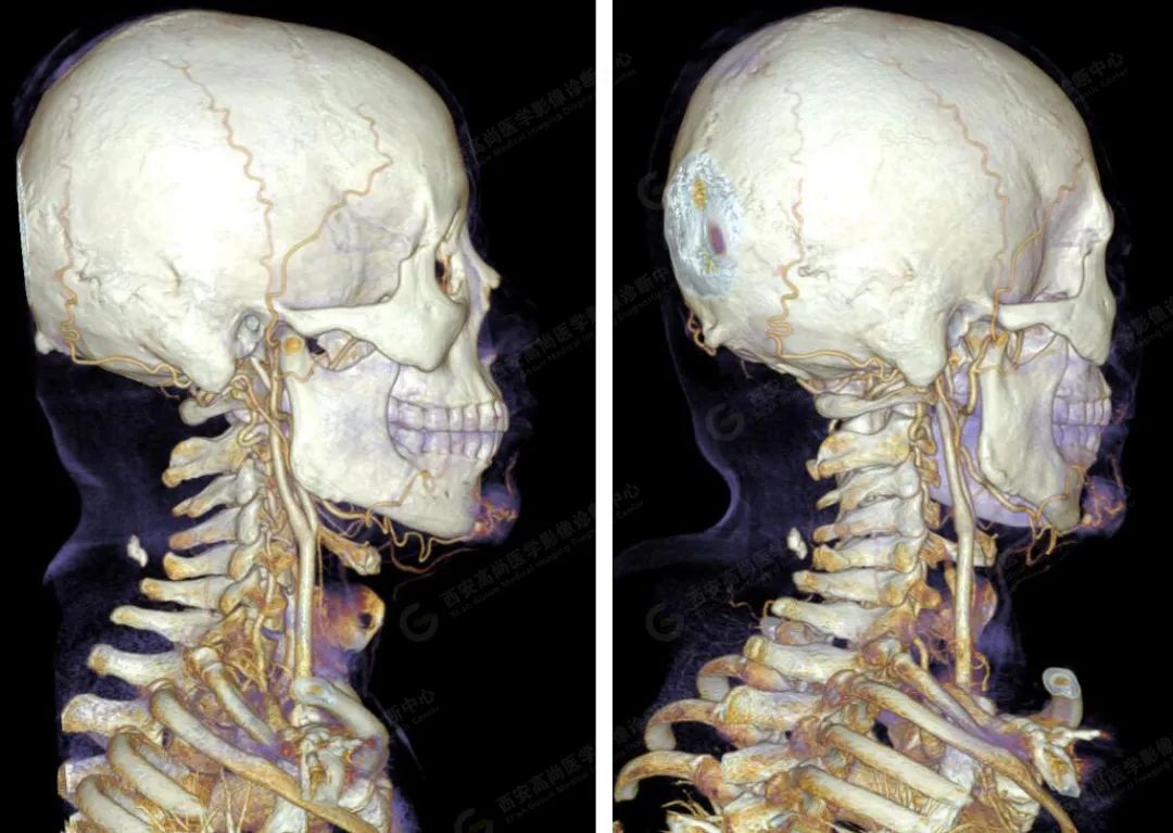高尚病例：颌面部血管畸形 CTA、CTV 成像技术应用