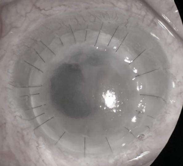 西安交通大学第二附属医院眼科完成一例穿透性角膜移植术治疗严重真菌性角膜溃疡