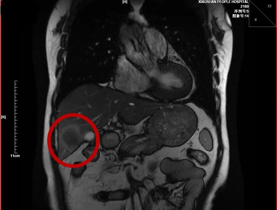 千里寻医，萧山医生为河南奶奶摘除两处肿瘤