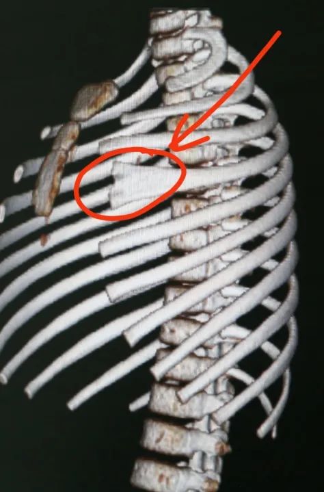 CT 一拍，发现 4 岁小男孩肋骨开叉了！专家：儿童胸壁畸形还真不少见