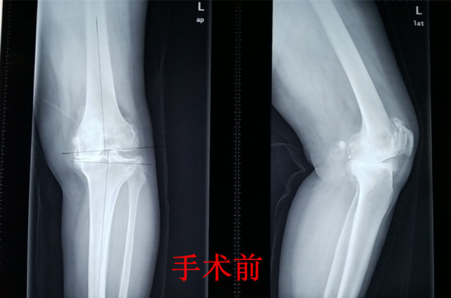 淄博万杰：「全膝关节表面置换术」+无陪护专业护理，助力患者早康复