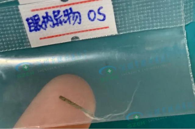 深圳男子被 1 厘米铁条扎入眼内，2 月后才发现…