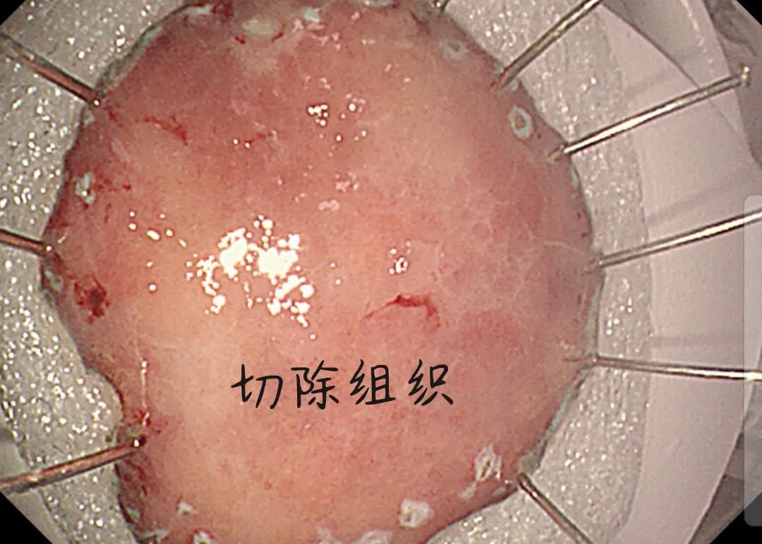 岳池县人民医院成功开展县域首例经内镜下胃早癌切除术