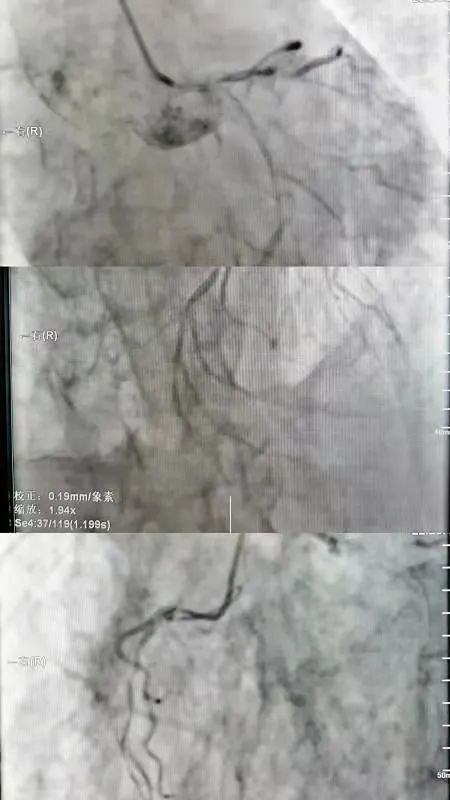 延安大学附属医院成功实施主动脉球囊反搏下冠状动脉旁路移植术