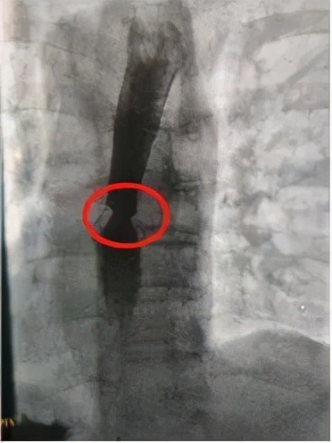 保持「吃烫饭」的习惯，竟让他患上癌症